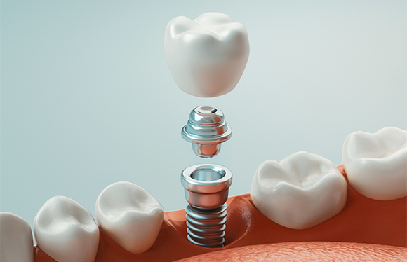 ➀「歯周インプラント認定医による、質の高いインプラント治療」