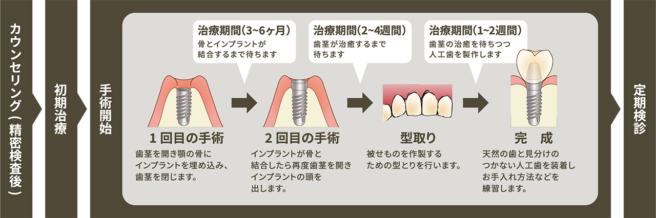 インプラントの治療の流れ