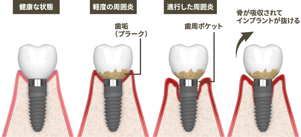 インプラント治療もメインテナンスが必須！