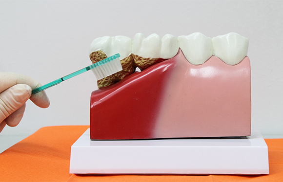 １、歯周病は「骨」の病気