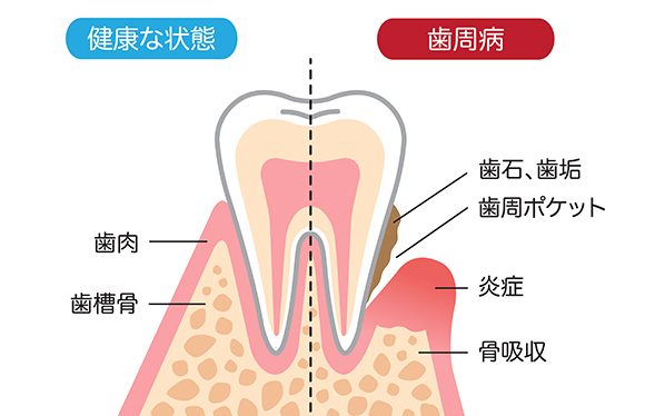 歯周病は症状が現れにくい