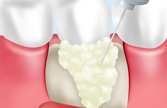 歯周組織再生療法