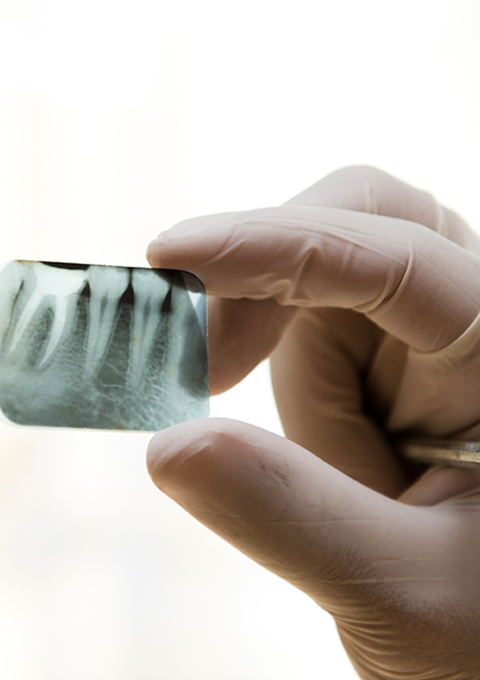 歯の神経の保存にこだわった歯髄保存療法